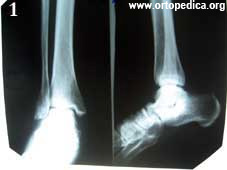 Рентгенография стопы - артроз подтаранного сустава