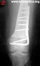 до операции остеоартроз коленного сустава с вальгусной деформацией сустава