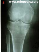  Рентгенография коленного сустава при остеоартрозе